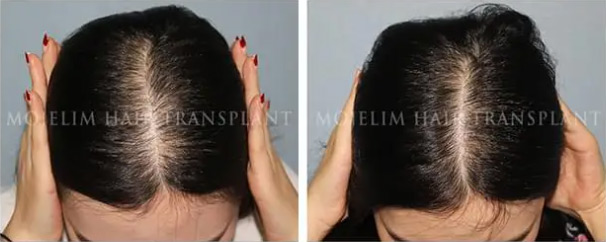 Women — 5 months of MOJELIM hair-loss treatment