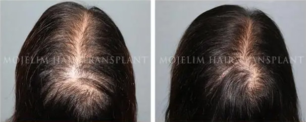 Women — 4 months of MOJELIM hair-loss treatment