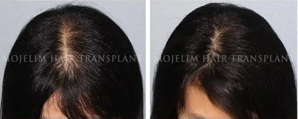Women — 5 months of MOJELIM hair-loss treatment