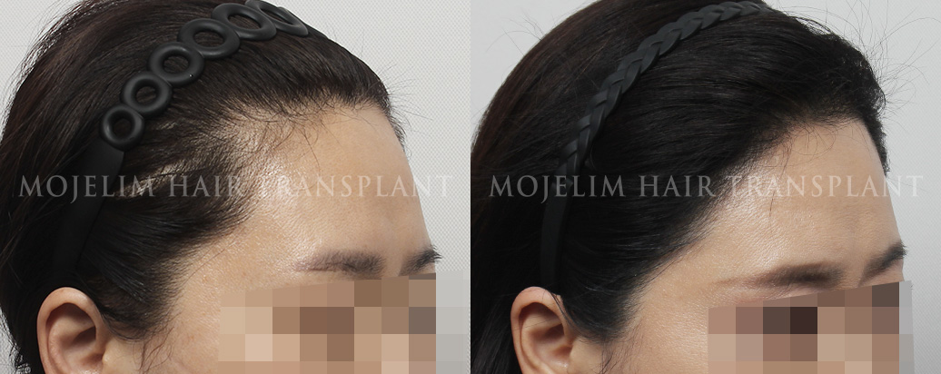 FUT hairline correction, 2,200 hairs