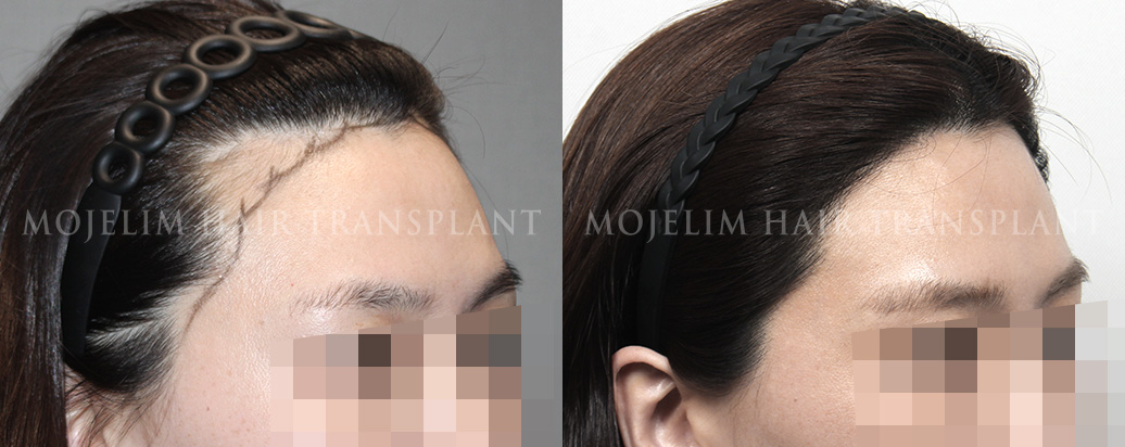 FUE hairline correction, 1,500 hairs