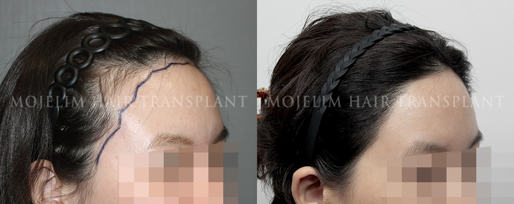 FUT hairline correction, 2,600 hairs