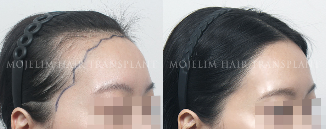 FUE hairline correction, 3,400 hairs