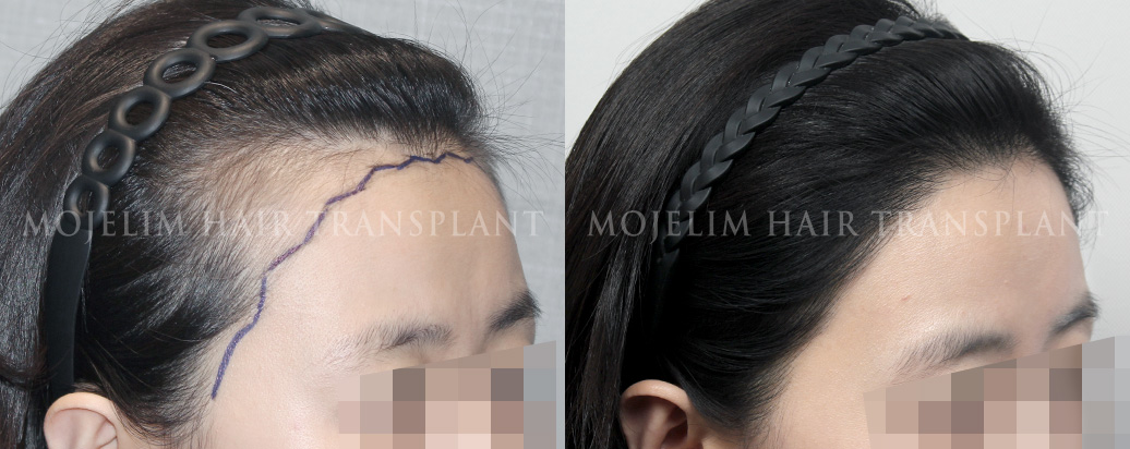 FUT hairline correction, 2,500 hairs