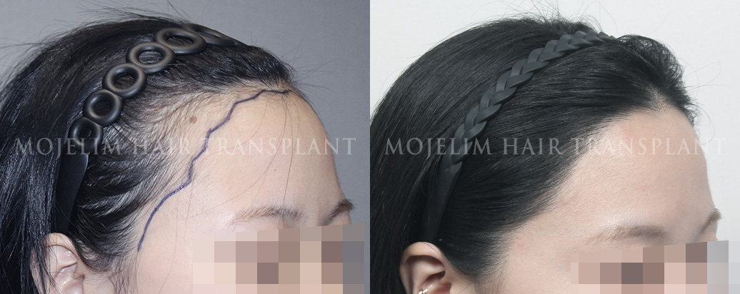 FUE hairline correction, 2,400 hairs