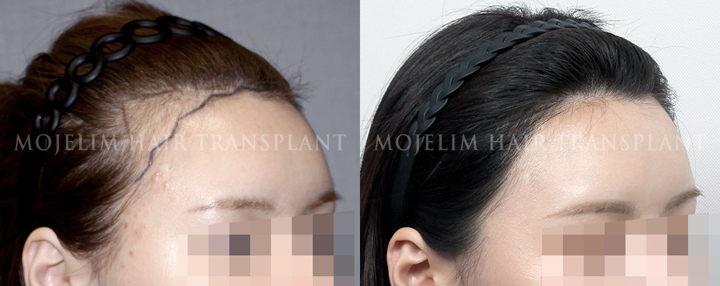 FUE hairline correction, 2,000 hairs