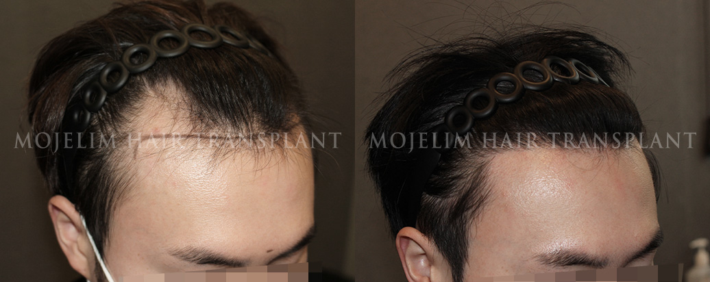 FUE hair transplant, 3,400 hairs
