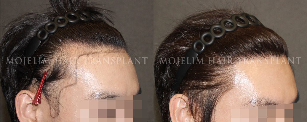 FUT hair transplant, 3,300 hairs