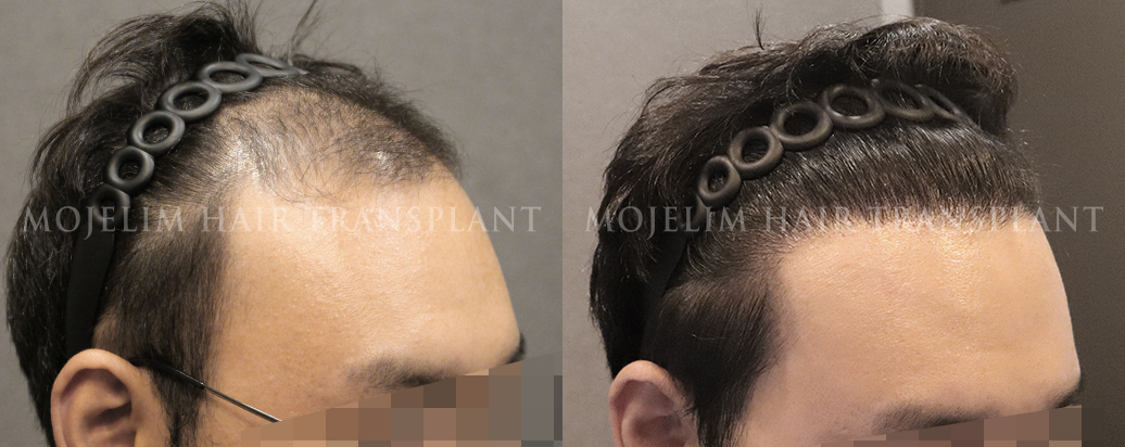 FUE hair transplant, 4,400 hairs