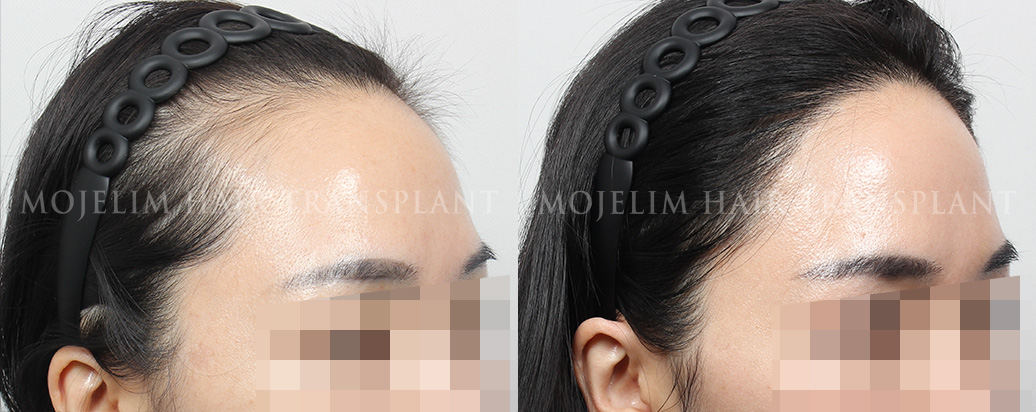 FUT hairline correction, 2,500 hairs
