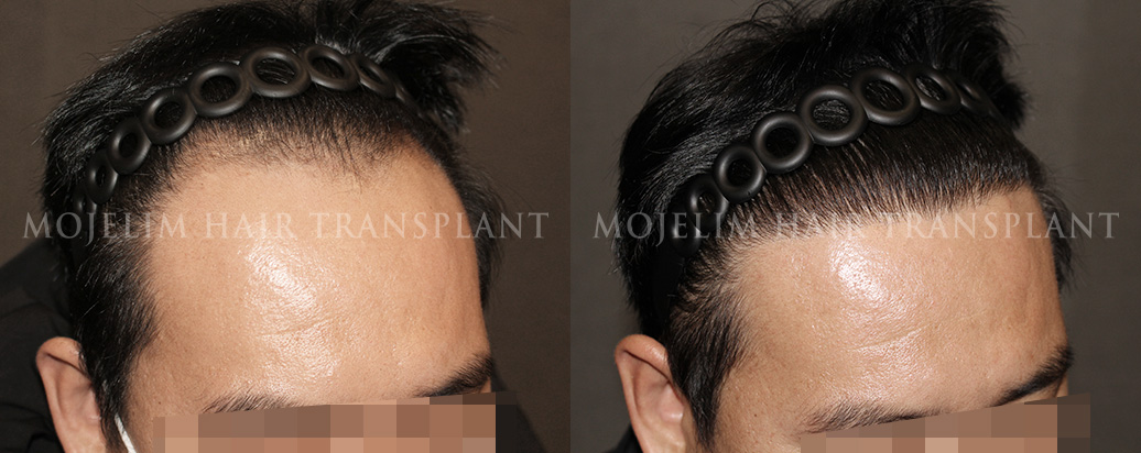 FUT hair transplant, 4,000 hairs