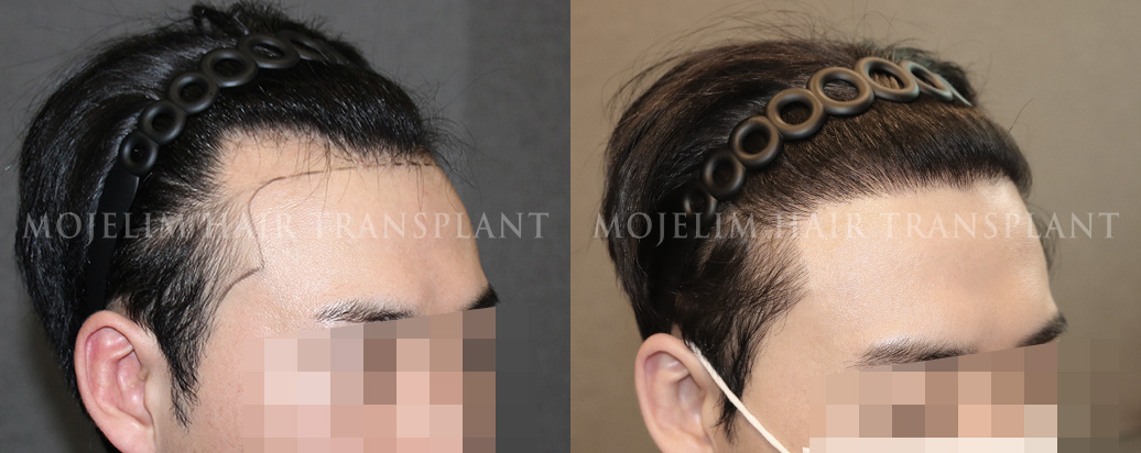FUT hair transplant, 3,200 hairs
