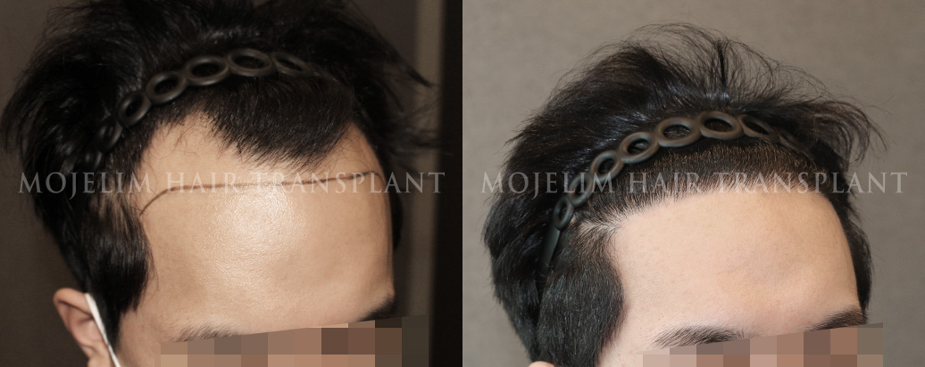 FUE hair transplant, 4,300 hairs