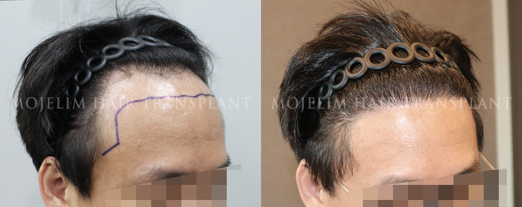 FUE hair transplant, 5,000 hairs