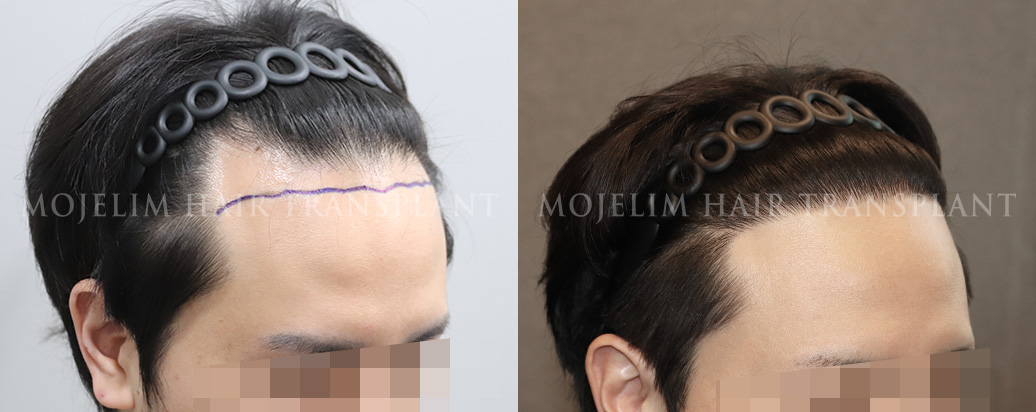 FUE hair transplant, 3,000 hairs