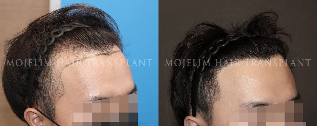 FUT hair transplant, 4,000 hairs