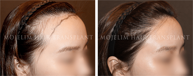 MOJELIM Hair Transplant