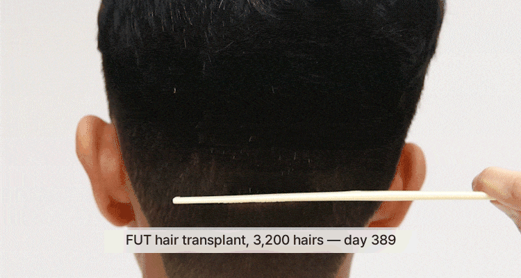 One year after FUT surgery